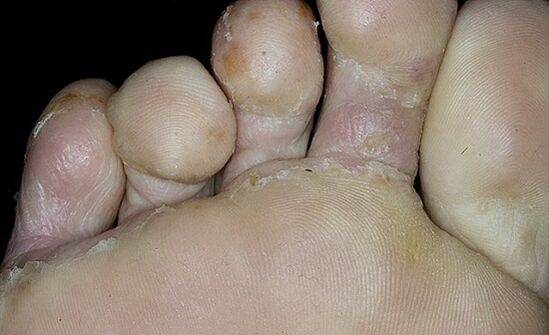 foot fungus