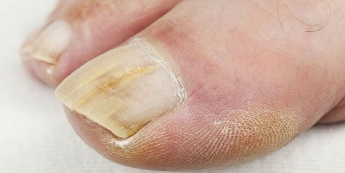 symptoms of nail fungus