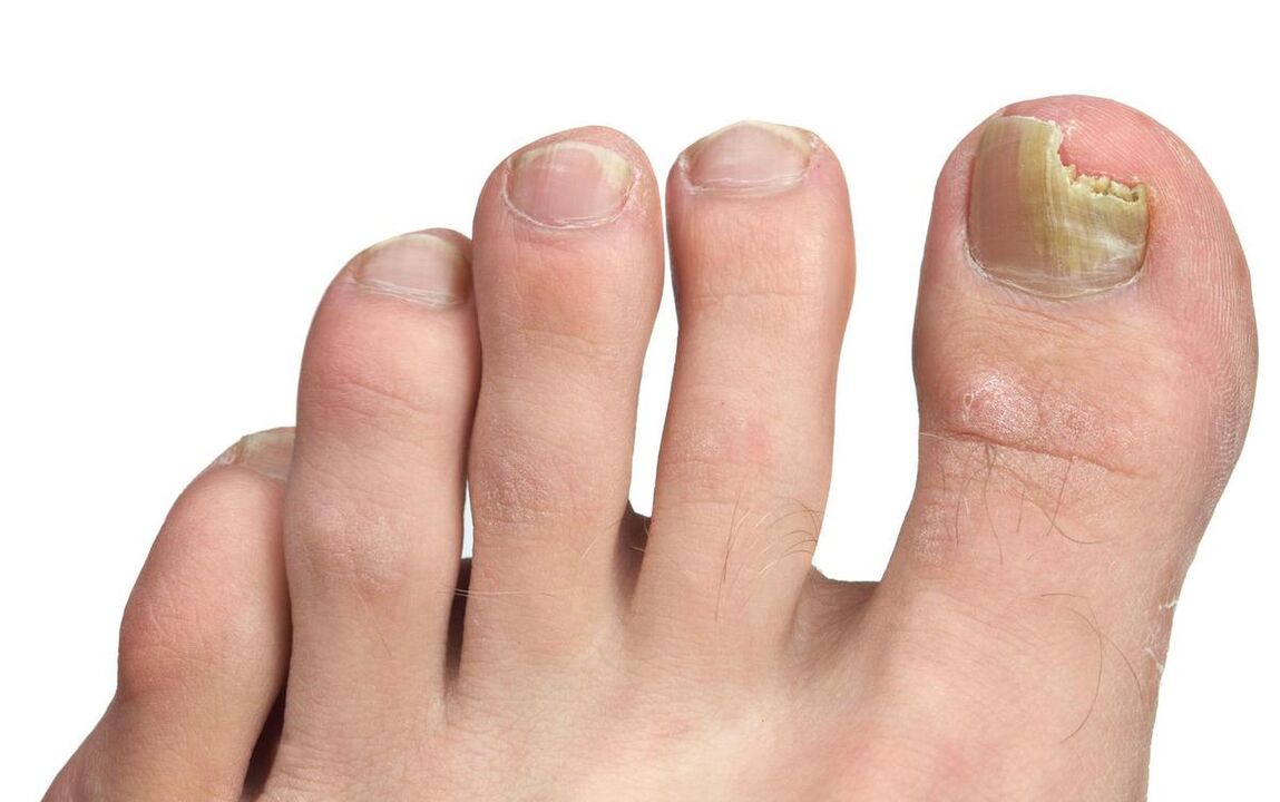fungal symptoms of the big toe photo 3