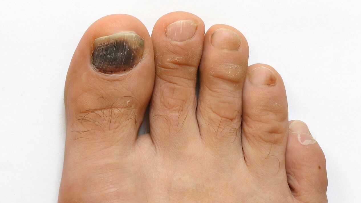fungal symptoms on the big toe photo 2
