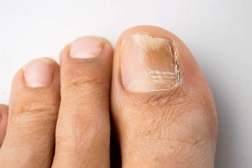 fungal symptoms on the big toe photo 4