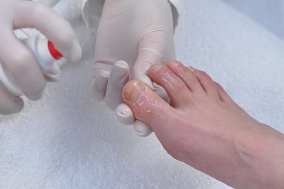 spray to treat nail fungus