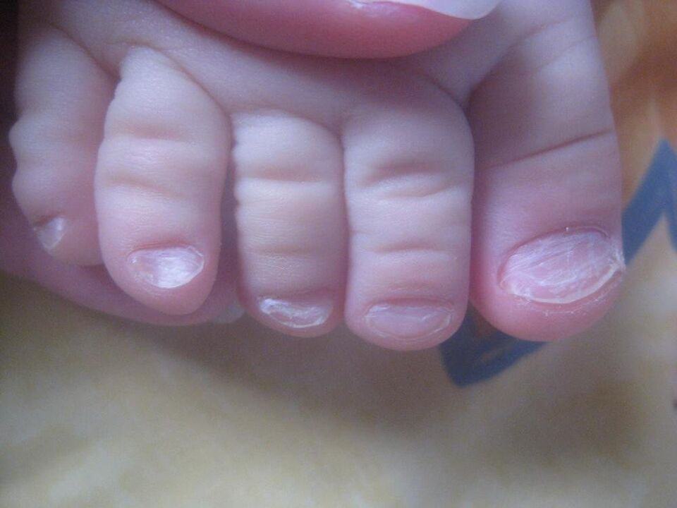 mushrooms on the nails in children