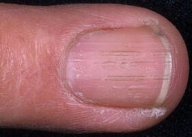 nail fungus signs
