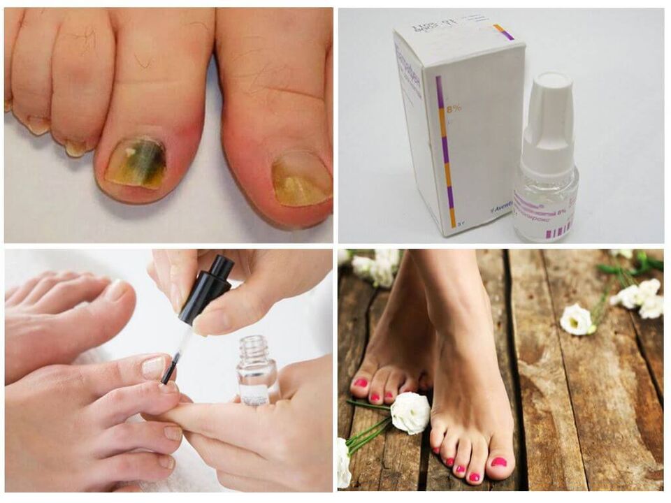 how to use anti-fungal varnishes