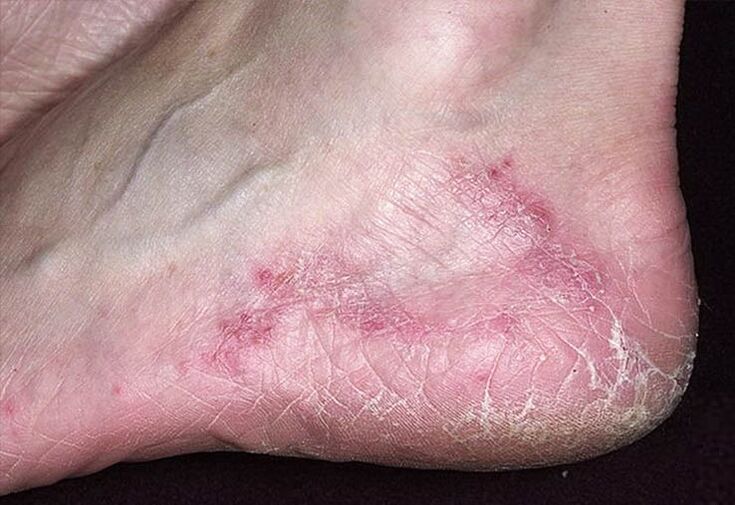 Cracks and redness in the skin of the heel are signs of a fungal infection