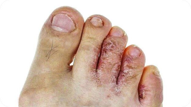 How athlete's foot appears