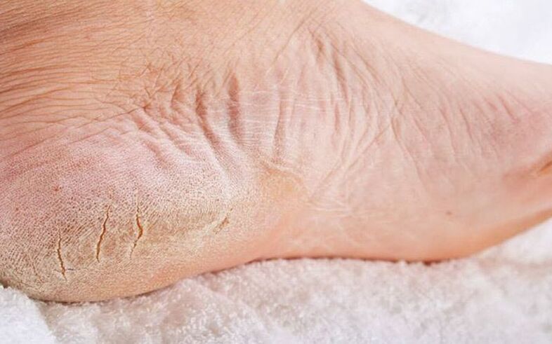 athlete's foot symptoms