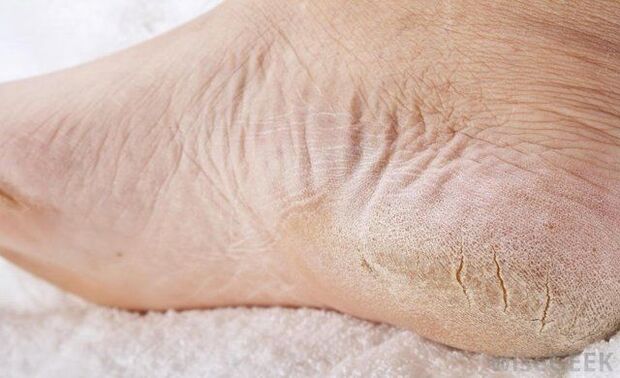 dry foot is a sign of fungus