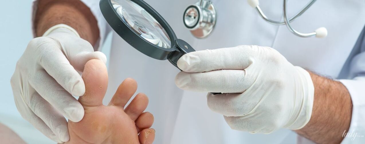 The doctor examines the toe fungi