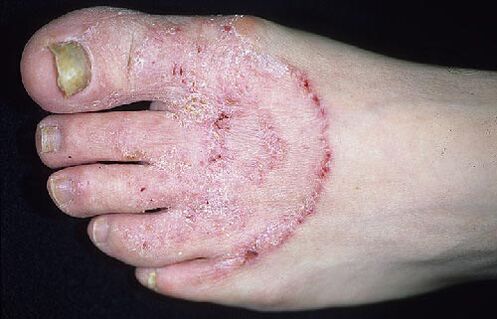 Leg and nail fungus