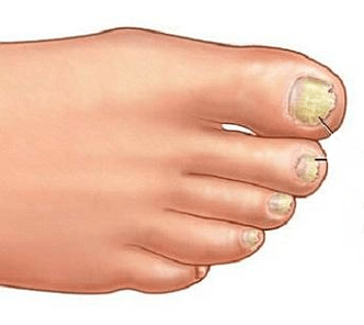 Onchomycosis