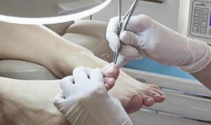 Nail surgical removal in the presence of fungus