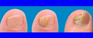 Stages of mushroom development on the toes