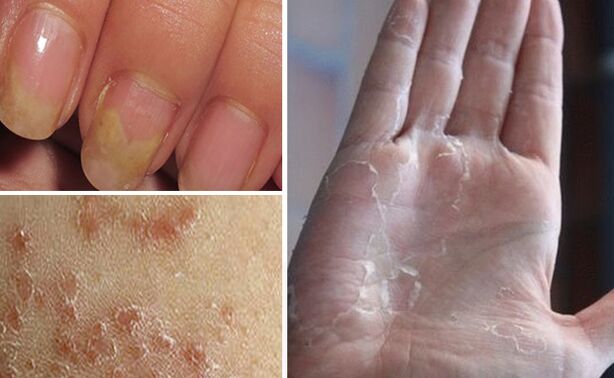 Can switch to mycosis to other parts of the body