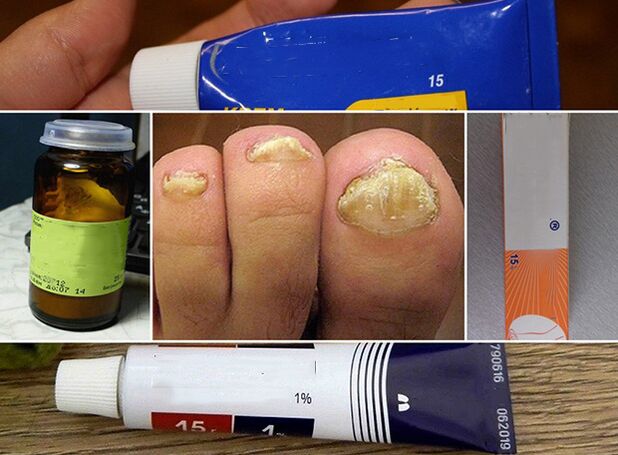 General Principles of Treatment of Fungus