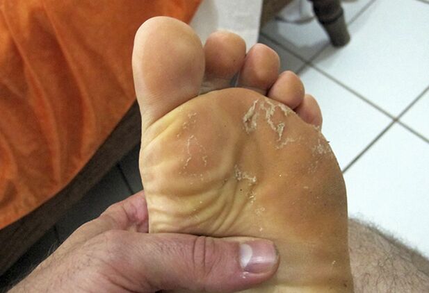 mushroom on the skin of the legs