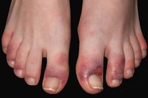 fungal symptoms on the toes