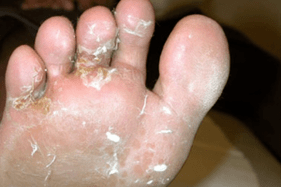 fungus on fingers and toes