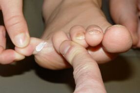 fungus on the toes