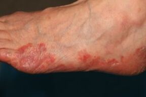 manifestation of fungus on the leg