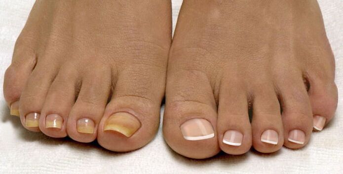 healthy nails and nails affected by the fungus