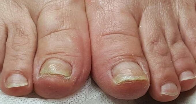 damage to the nails fungus on the legs