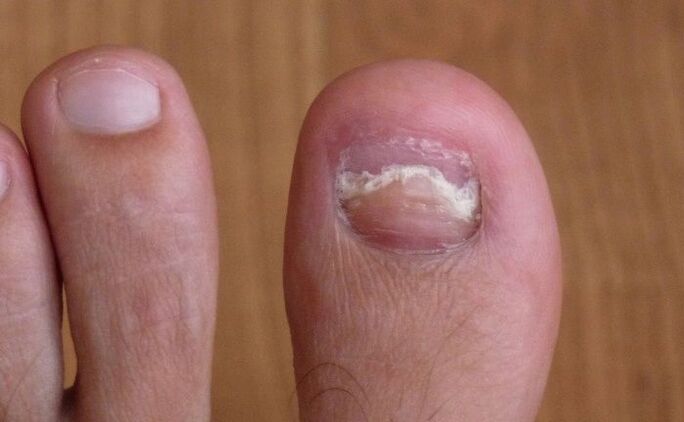 damage to the toe of the big toe with a fungus