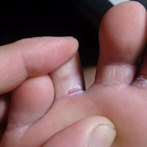 crack in the toes between fungus symptoms